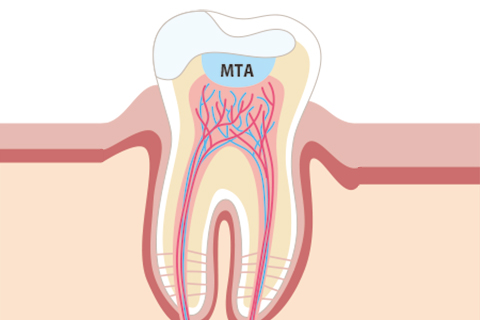 MTA(歯髄保存療法)